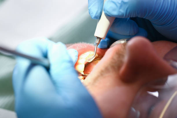 Urgent Tooth Repair in GA