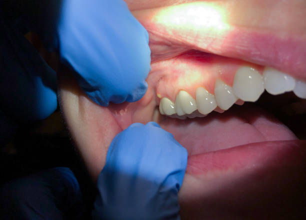 Best Chipped Tooth Repair Near Me  in Rutledge, GA